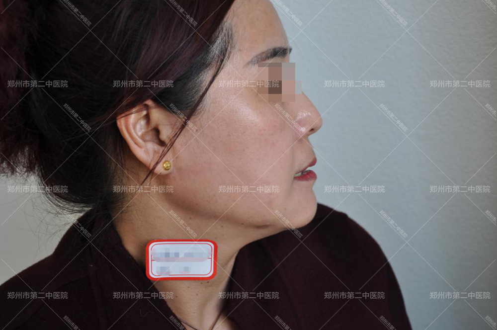 郑州哪家医院修复凹疤痕比较好,郑州祛凹陷疤痕的医院