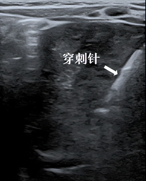 萌娃长肿瘤，“穿刺”定乾坤——郑大三附院成功实施超声引导下肝脏肿瘤穿刺活检术