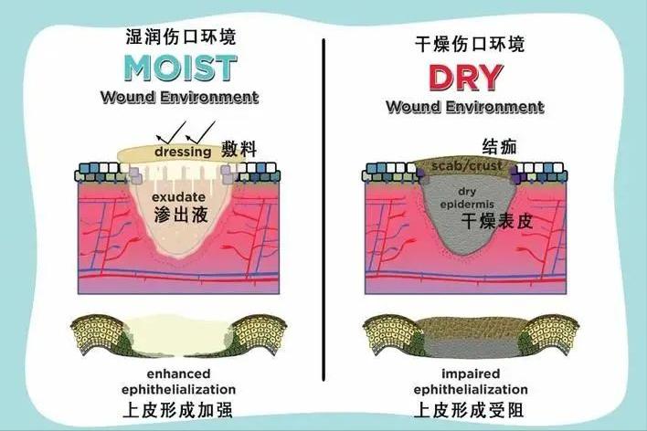 伤口湿性愈合和干性愈合的区别,干性愈合过程