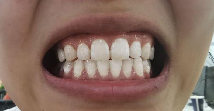 抽烟时间越长牙越黑?这些小众真神了,操作好瞬间黑牙变白牙!