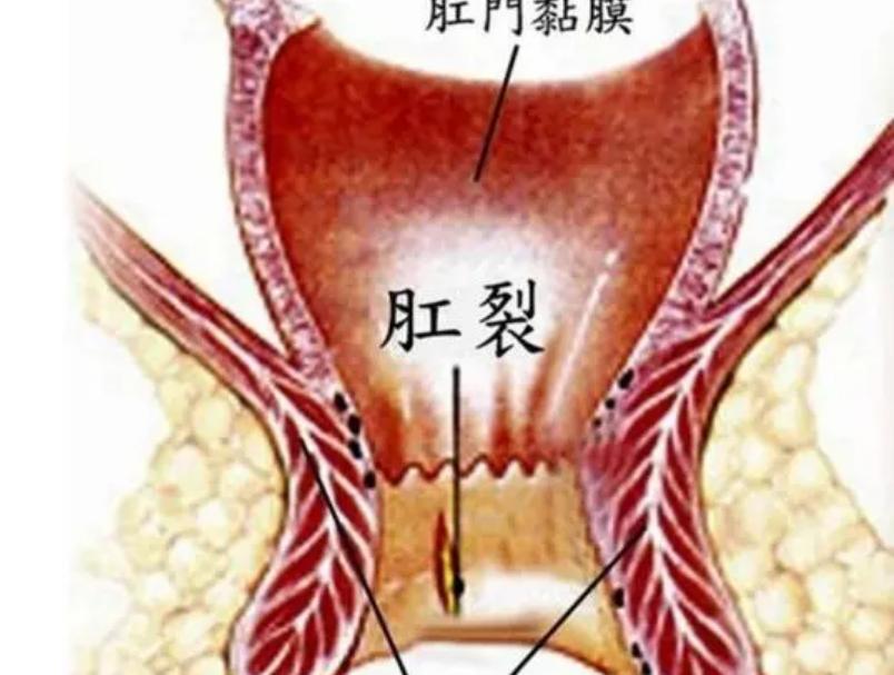 为什么会出现肛裂这样的情况,肛裂为什么女性居多