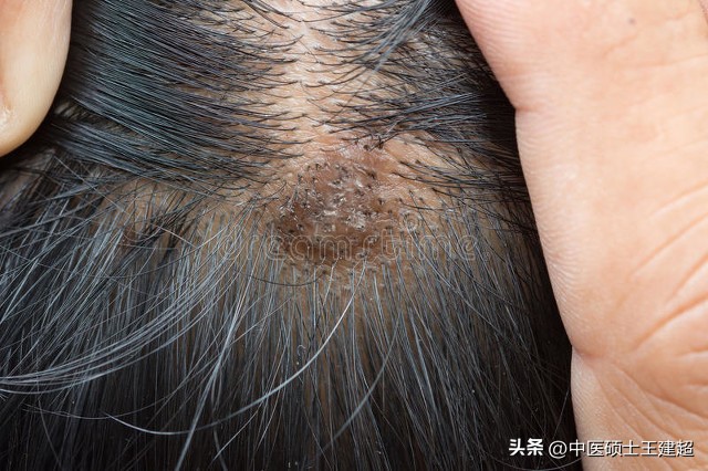 脱发了如何不焦虑,脱发不用慌掉发严重试试这个方法