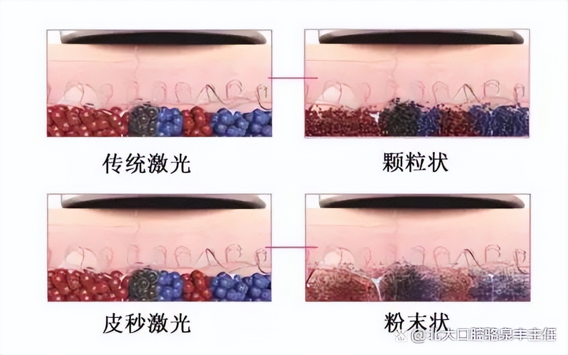 脉冲激光手术和超皮秒有什么区别,皮秒激光与传统激光有什么区别