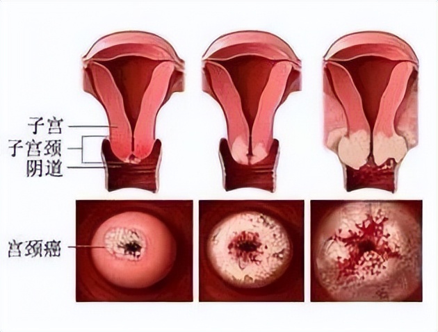 感染hpv导致宫颈癌还能治好吗,感染hpv导致癌变的几率