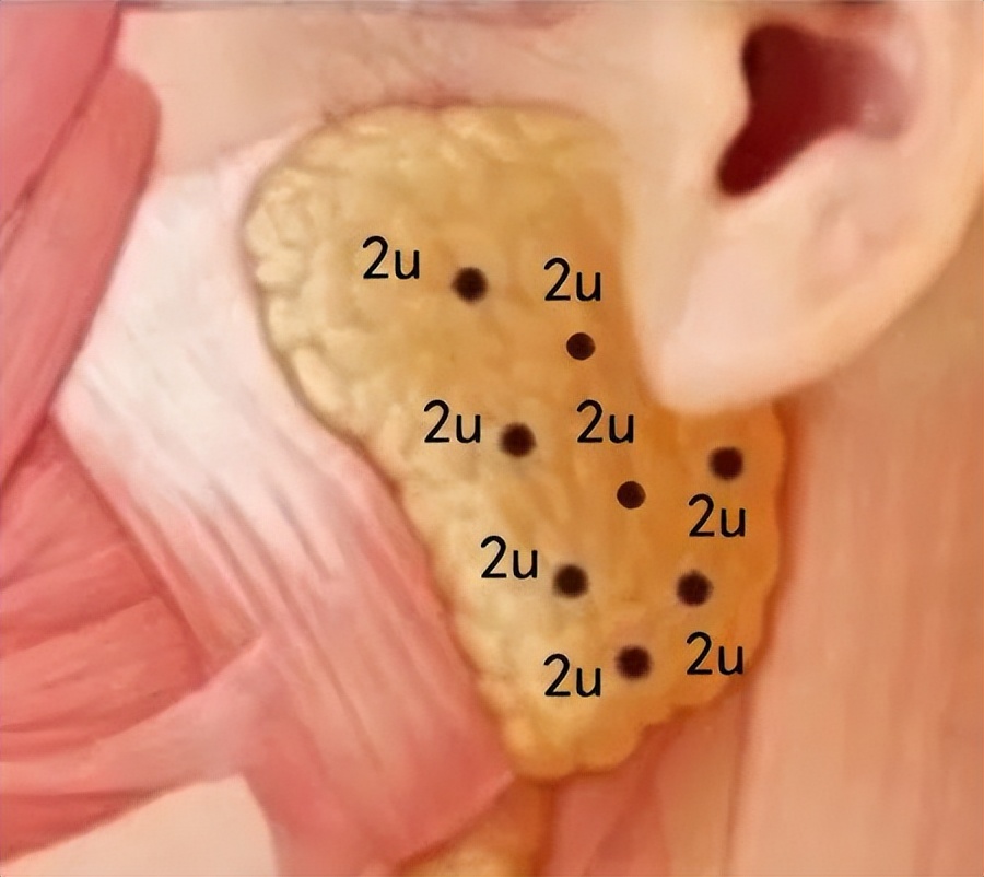 肉毒素打到腮腺,肉毒素可以打腮腺么