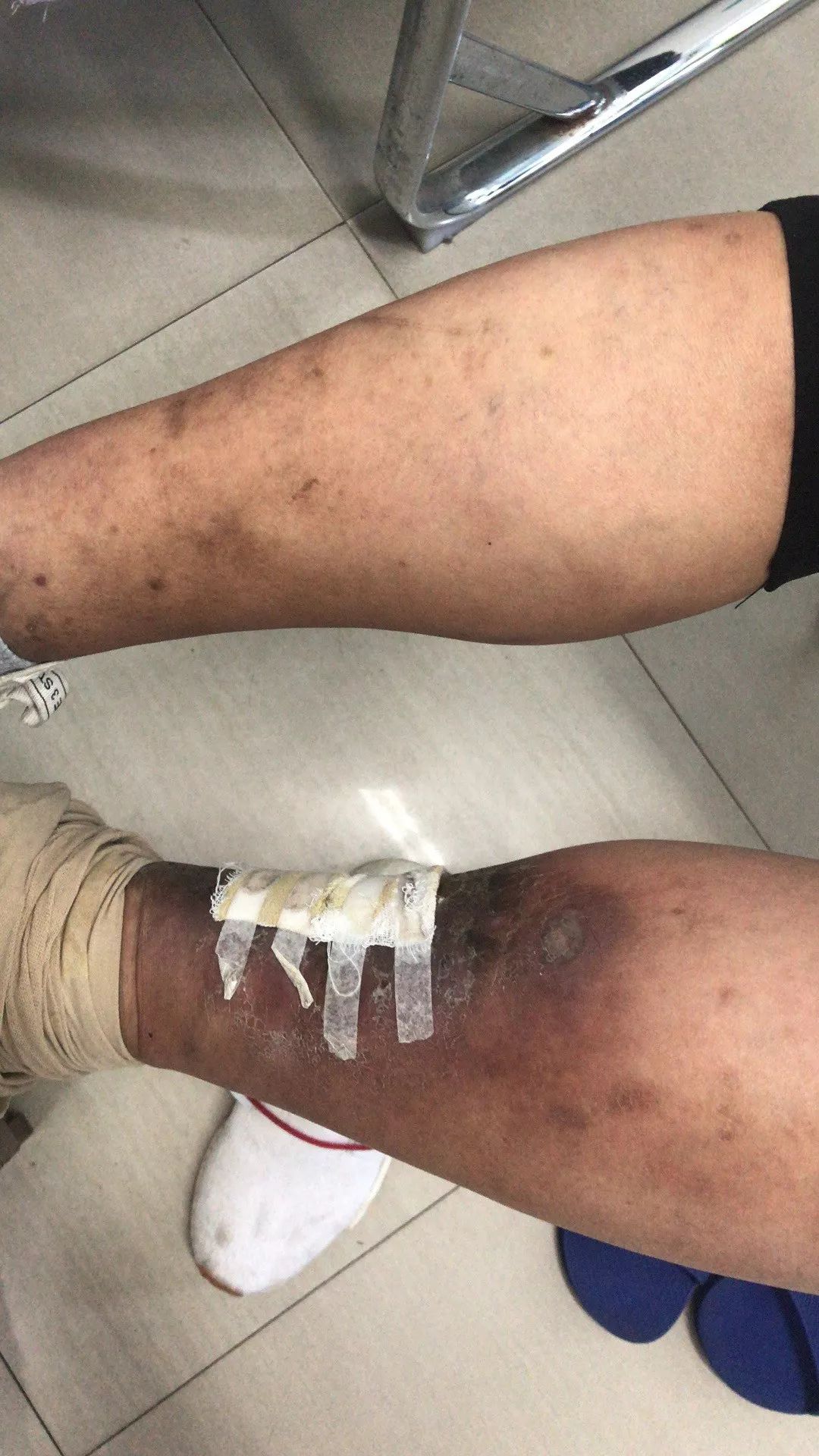 如何治疗静脉血栓,怎样治疗静脉血栓