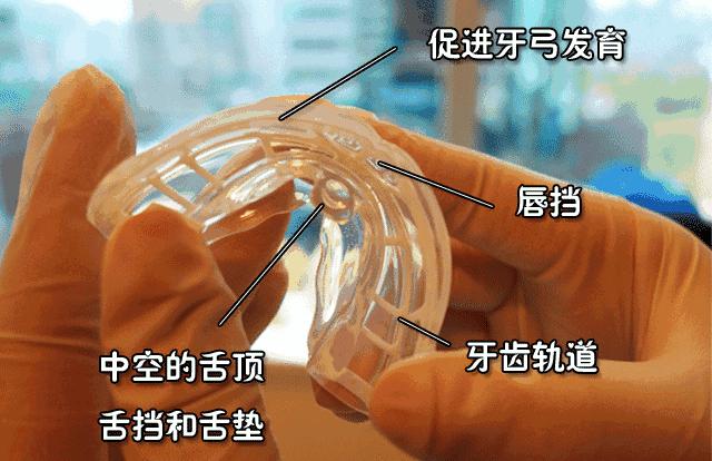 关于早期干预的案例,最新正畸技术