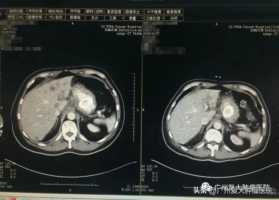 贲门癌晚期多器官转移,癌晚期多处转移