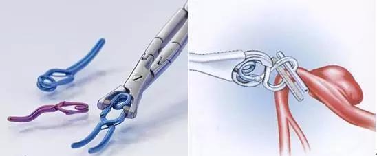 体内有金属植入患者怎么做核磁,体内有植入物可以做磁共振检查吗