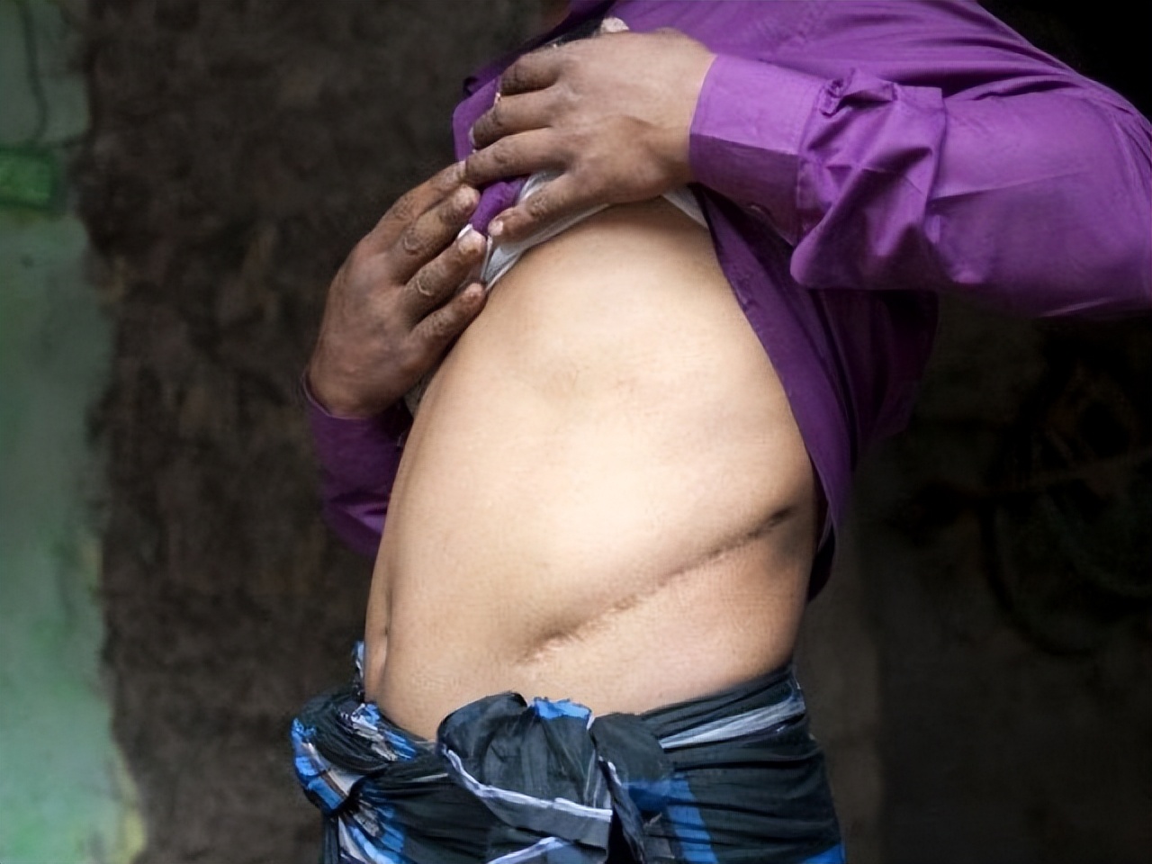 尼泊尔有个单肾村,尼泊尔单肾村的故事