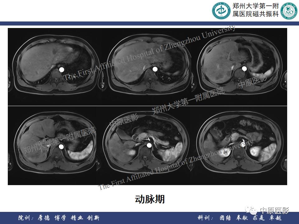 肝脏血管瘤样本,正确认识肝脏血管瘤文章