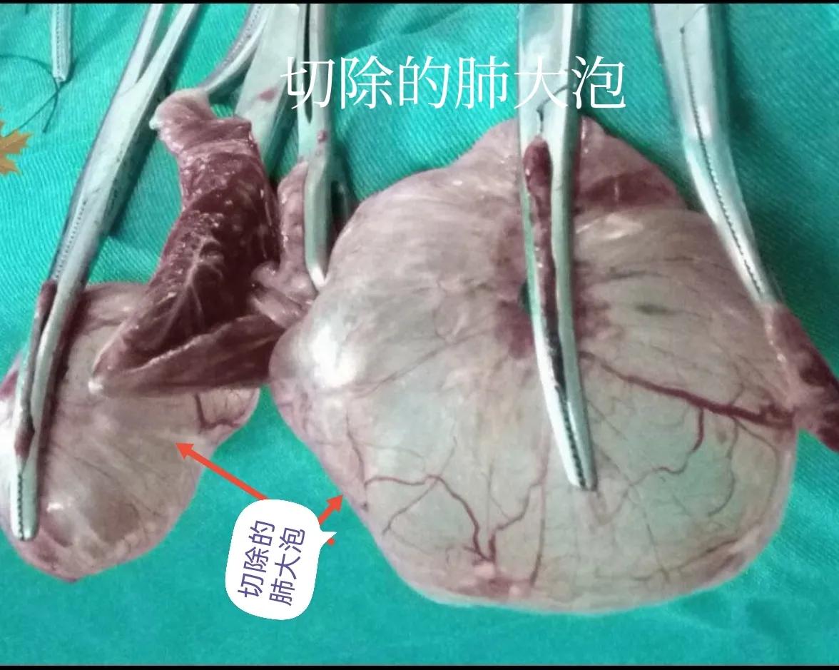 肺大泡产生的原因及治疗方案,肺大泡怎么治疗断根