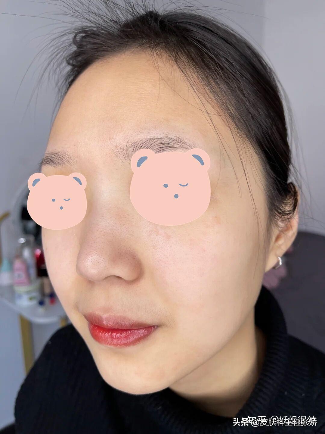 治疗黑头毛孔粗大,黑头治疗