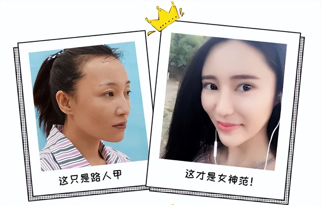 面部填充失败案例,脂肪填充面部失败案例