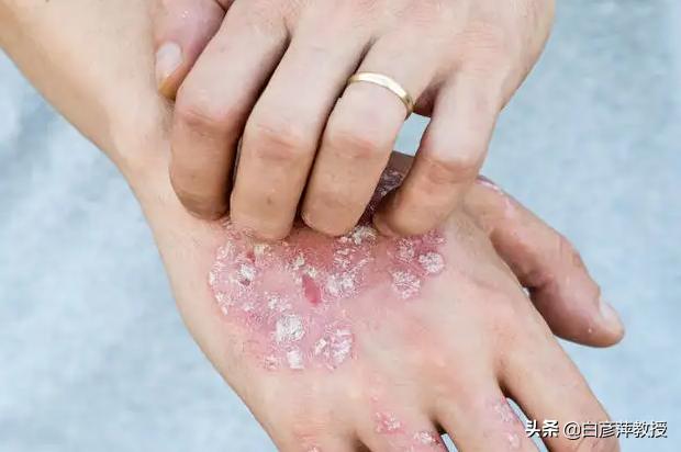 割耳放血可以治牛皮癣吗,民间老中医放血疗法治银屑病