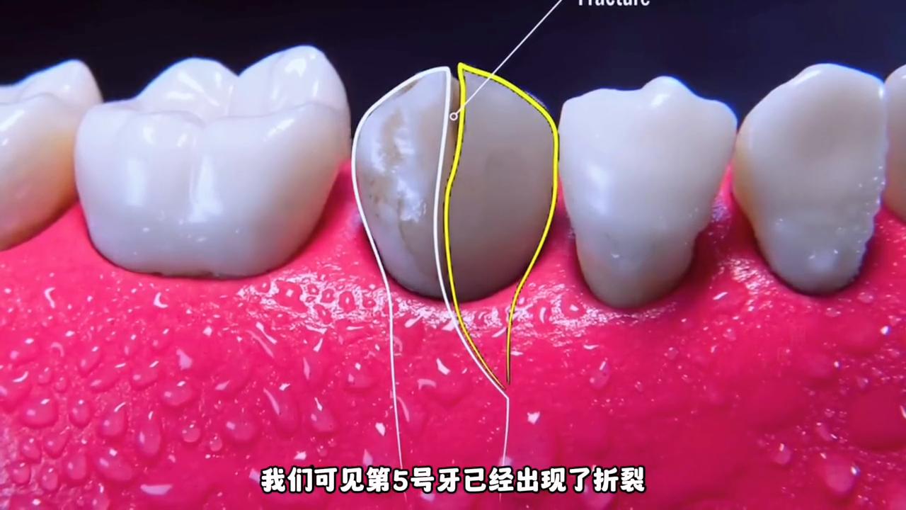 沉浸式牙处理,沉浸式弄牙齿