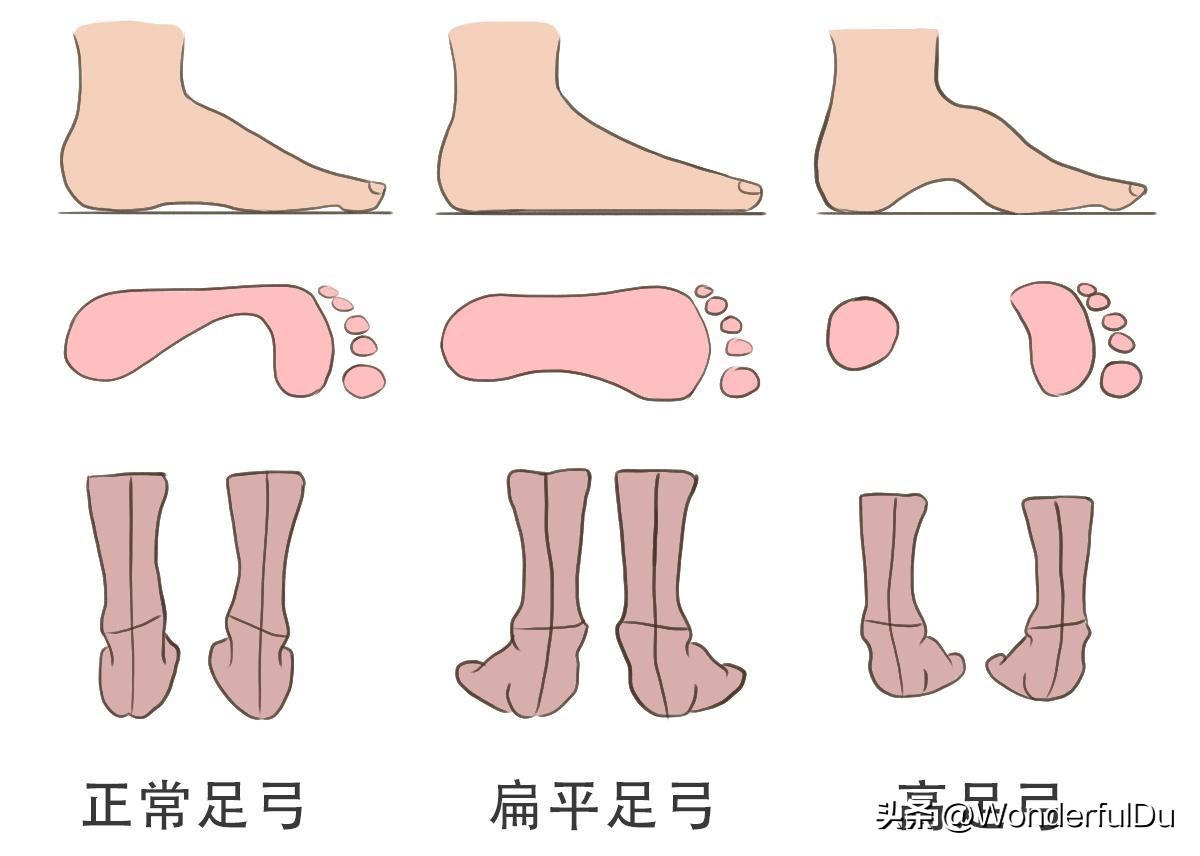 儿童脊柱侧弯导致长短脚怎样矫正,脊柱侧弯引起的长短脚能治愈吗