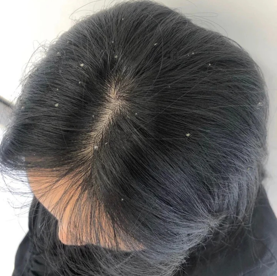 干性头皮屑去屑洗发水哪种最好,顽固性头屑用哪一款洗发水比较好