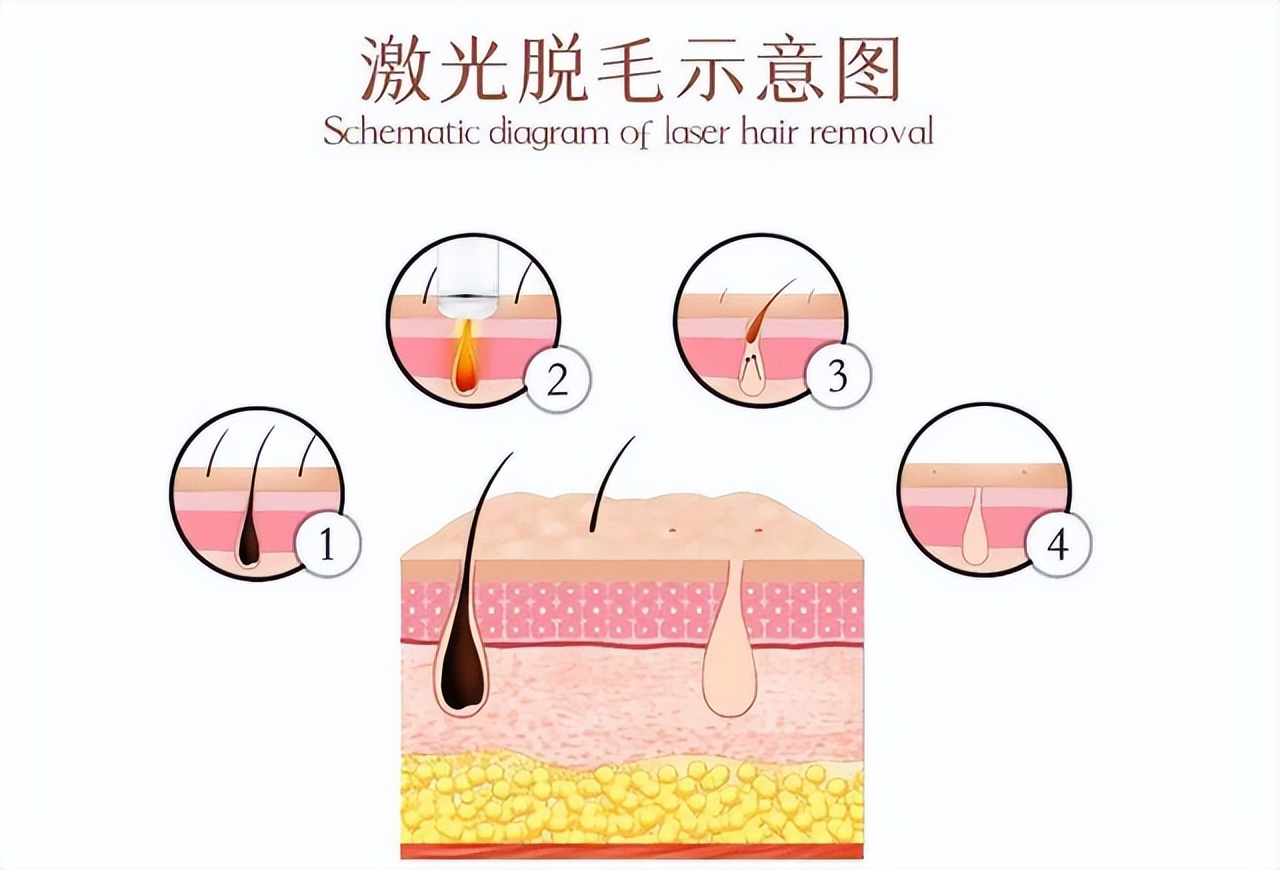 光子和脱毛谁更痛,光子与脱毛仪一样吗