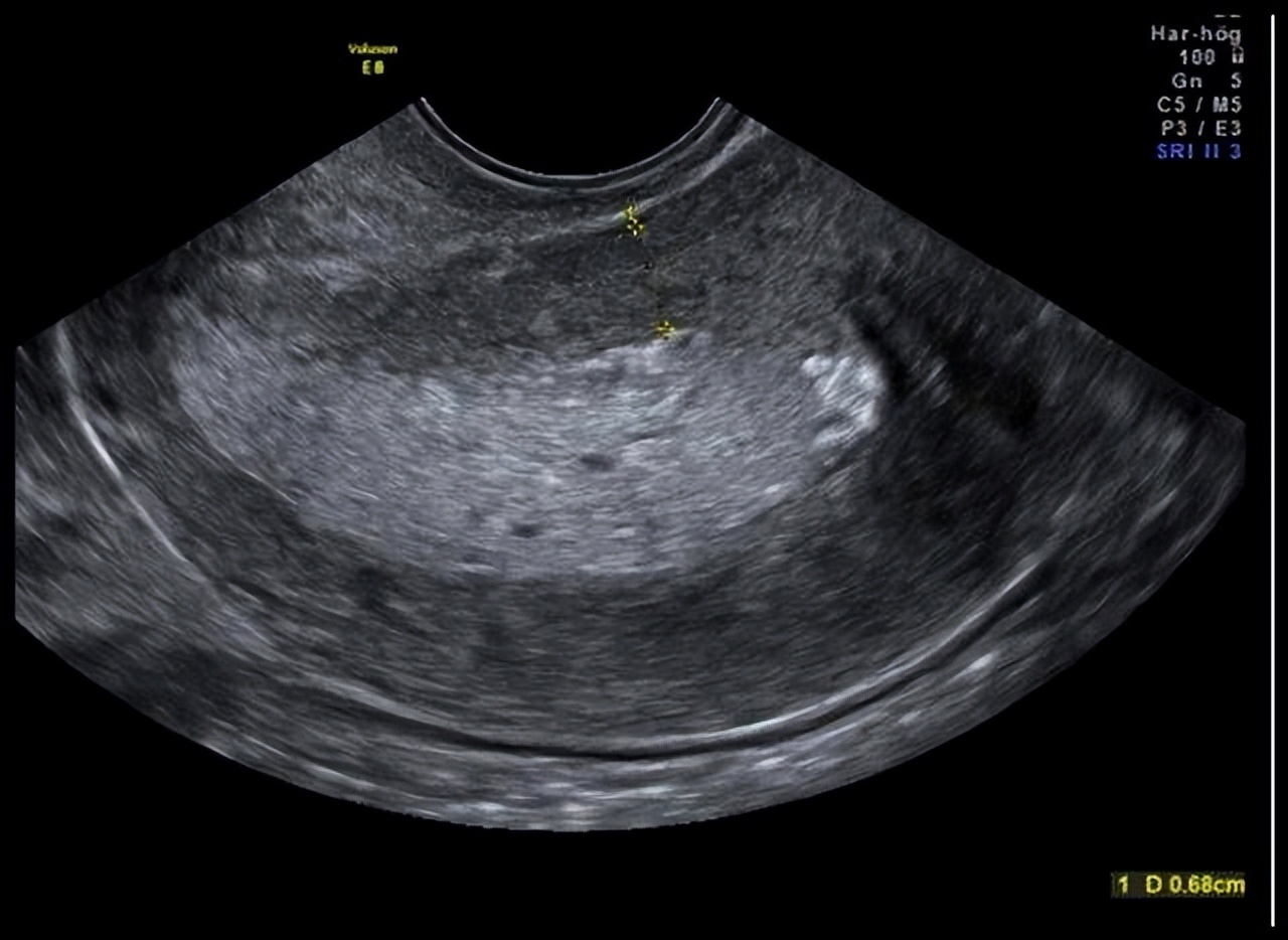 清宫后子宫内膜回声不均匀正常吗,产后子宫内膜回声不均匀什么意思