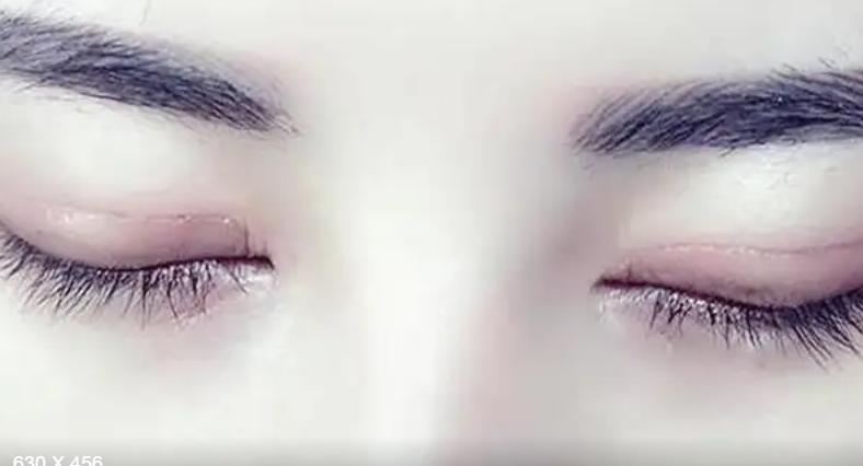 双眼皮做什么术式的好,微创双眼皮术式