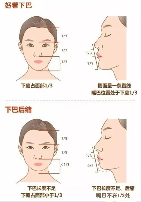 下巴后缩和下巴短怎么区分,下巴短小的原因