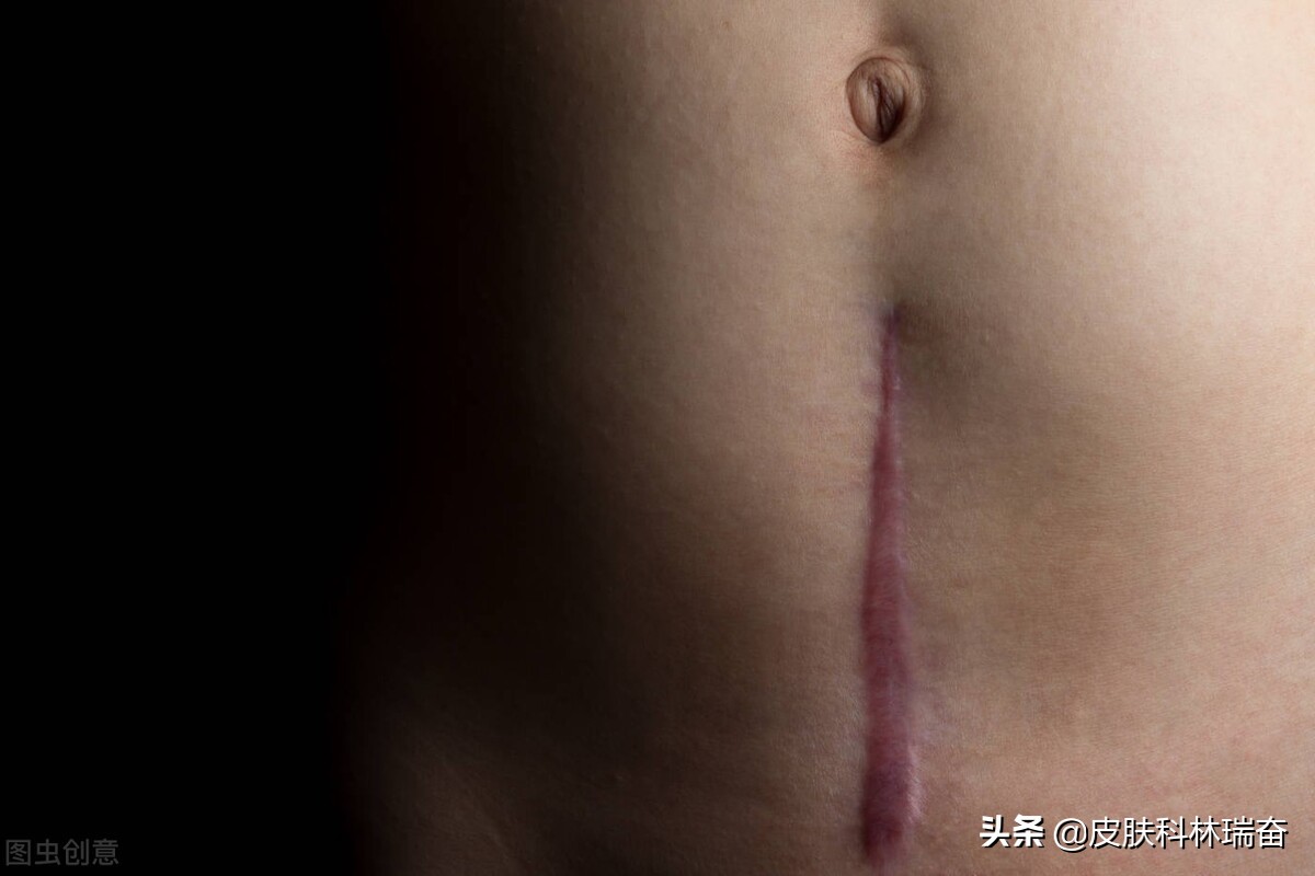 各种疤的修复方法,各种疤痕淡化