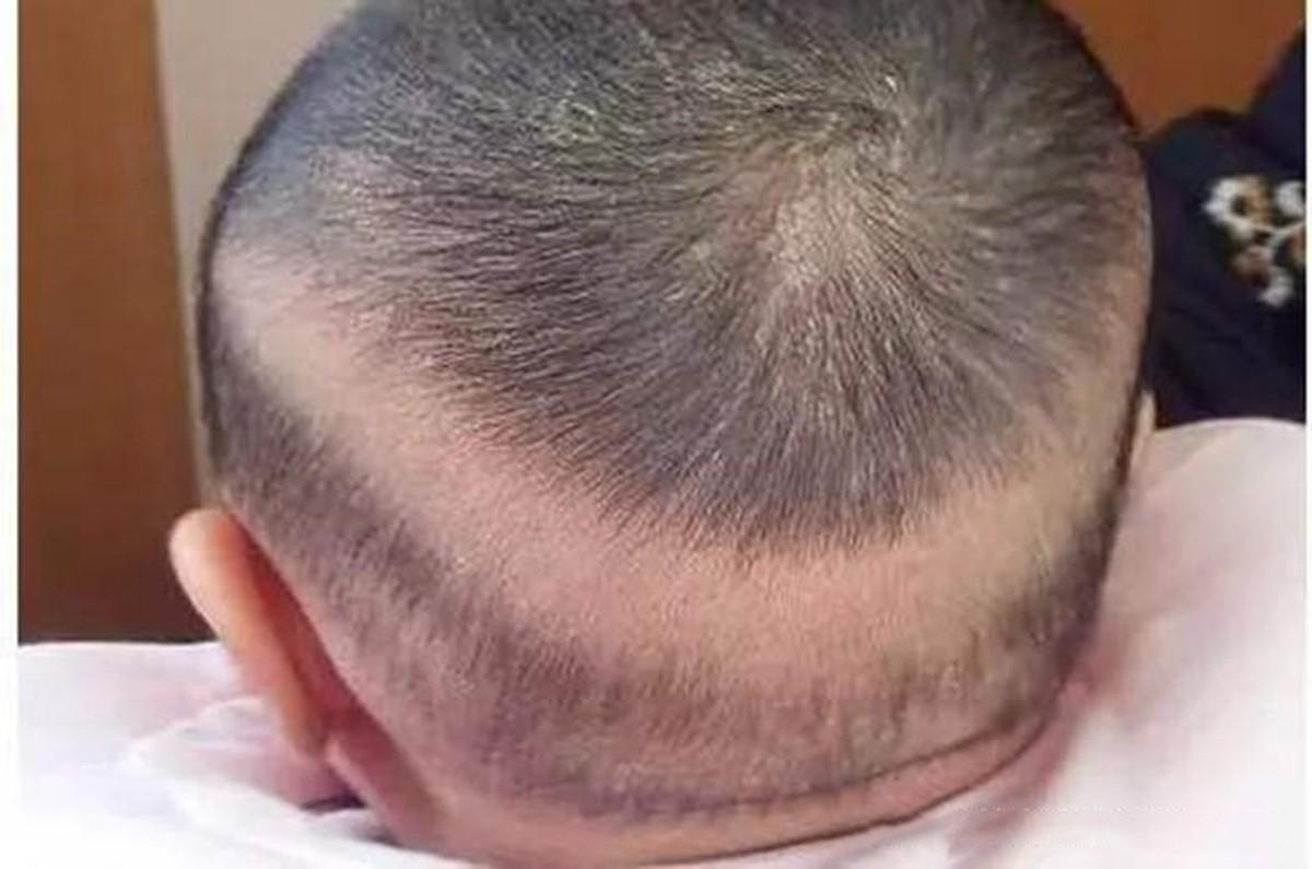 宝宝枕秃就是因为缺钙了是真的吗,宝宝有枕秃就是因为缺钙吗