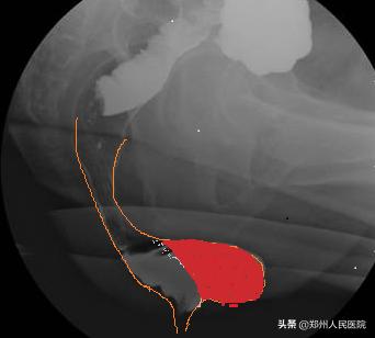 粑粑拉不出来是为什么,粑粑拉不出来按哪里