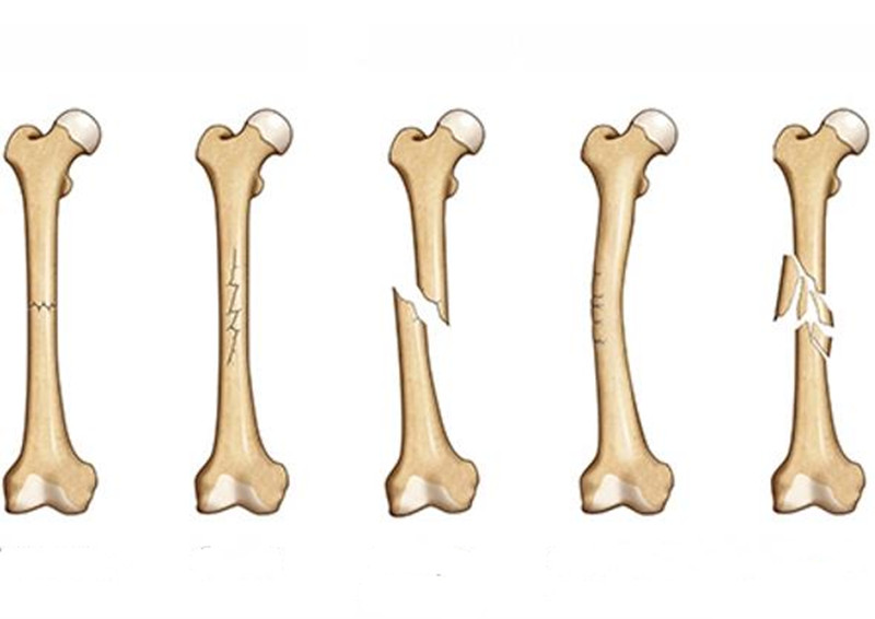 骨折后的征兆,骨折刚恢复后该注意什么