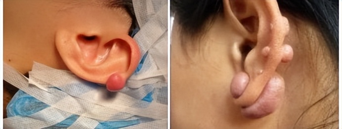 最难愈合的疤痕,无法治愈的疤痕