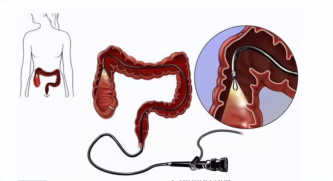 一次正常的肠镜可以确保多久,肠镜一次到底可以管多久