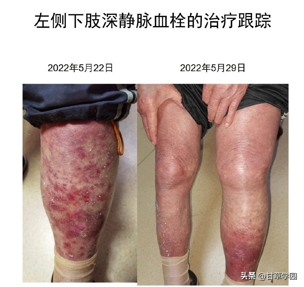 甘草芍药附子汤治静脉曲张医案,甘草芍药汤治疗静脉曲张医案