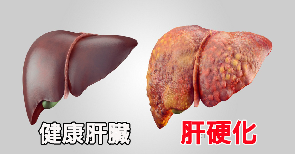 肝病专家贺彬治疗肝癌怎么样,肝病贺彬