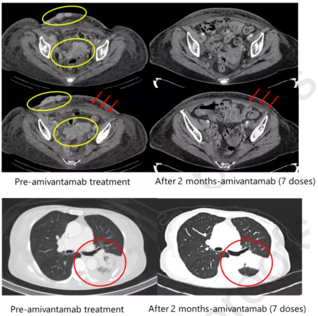 肺癌靶向药egfr,神奇的肺癌靶向药物