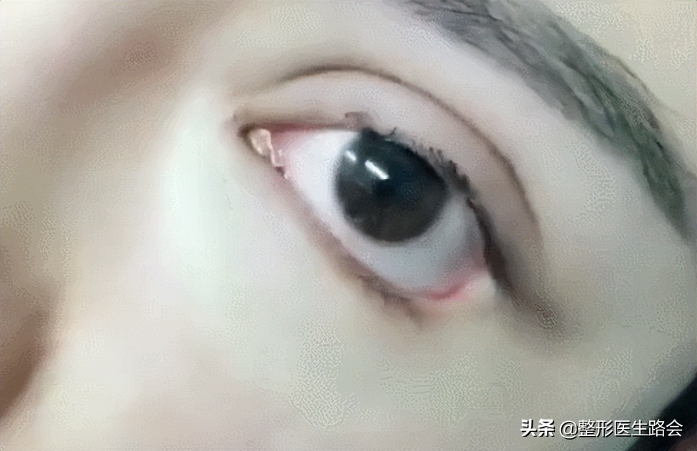 为什么医生不建议去三甲医院整形,为什么医生都不推荐做眼睑