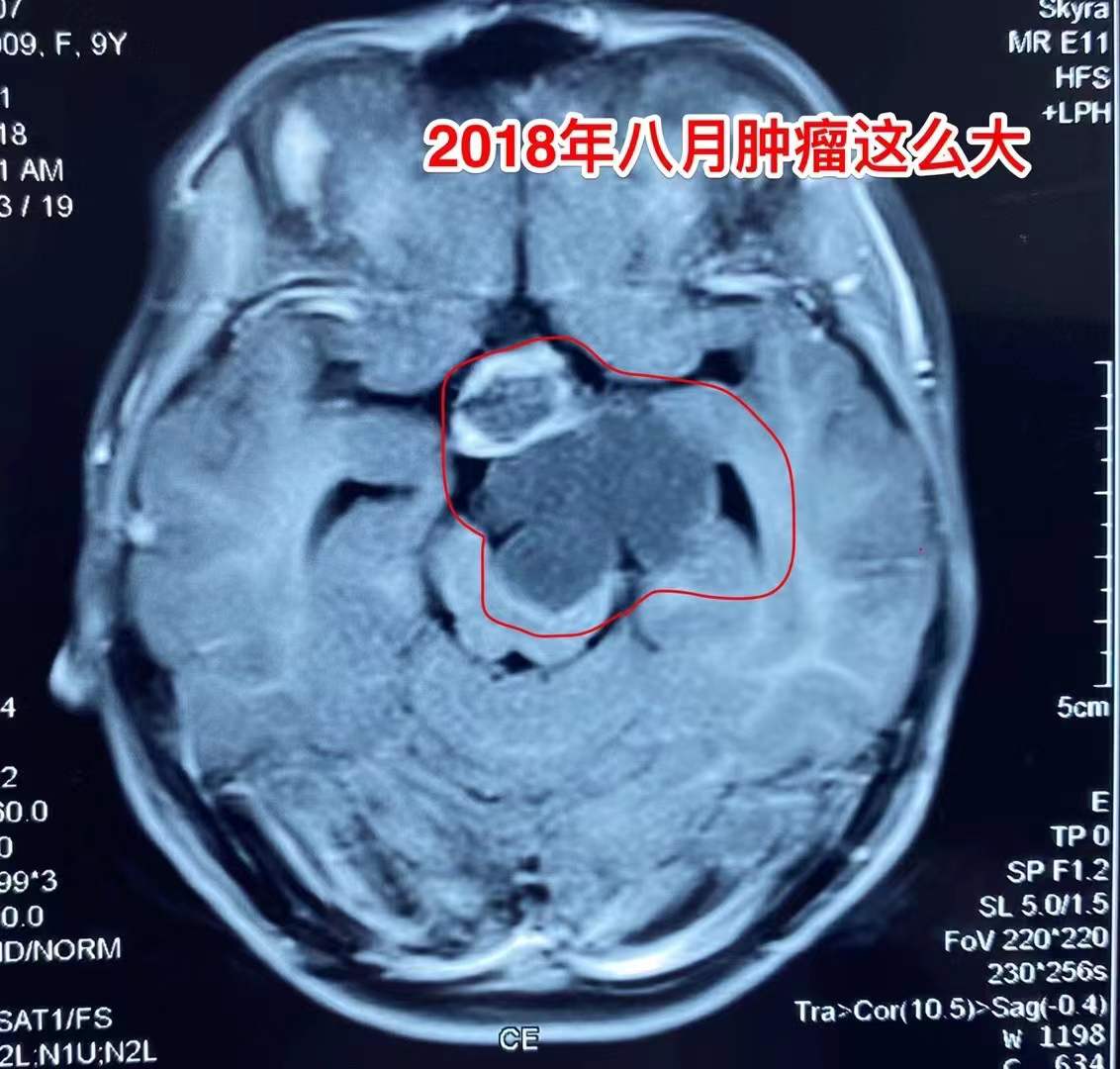 误区！吃中药能控制颅咽管瘤！颅咽管瘤最有效的治疗是手术