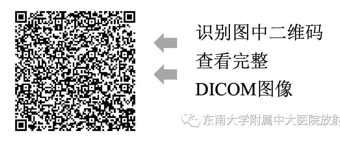 左腓骨下段骨折伴下胫腓联合分离,好文分享深度揭秘