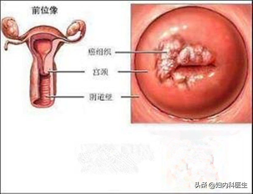 妇产科医生吓唬人,宫颈糜烂被医院吓唬说癌症
