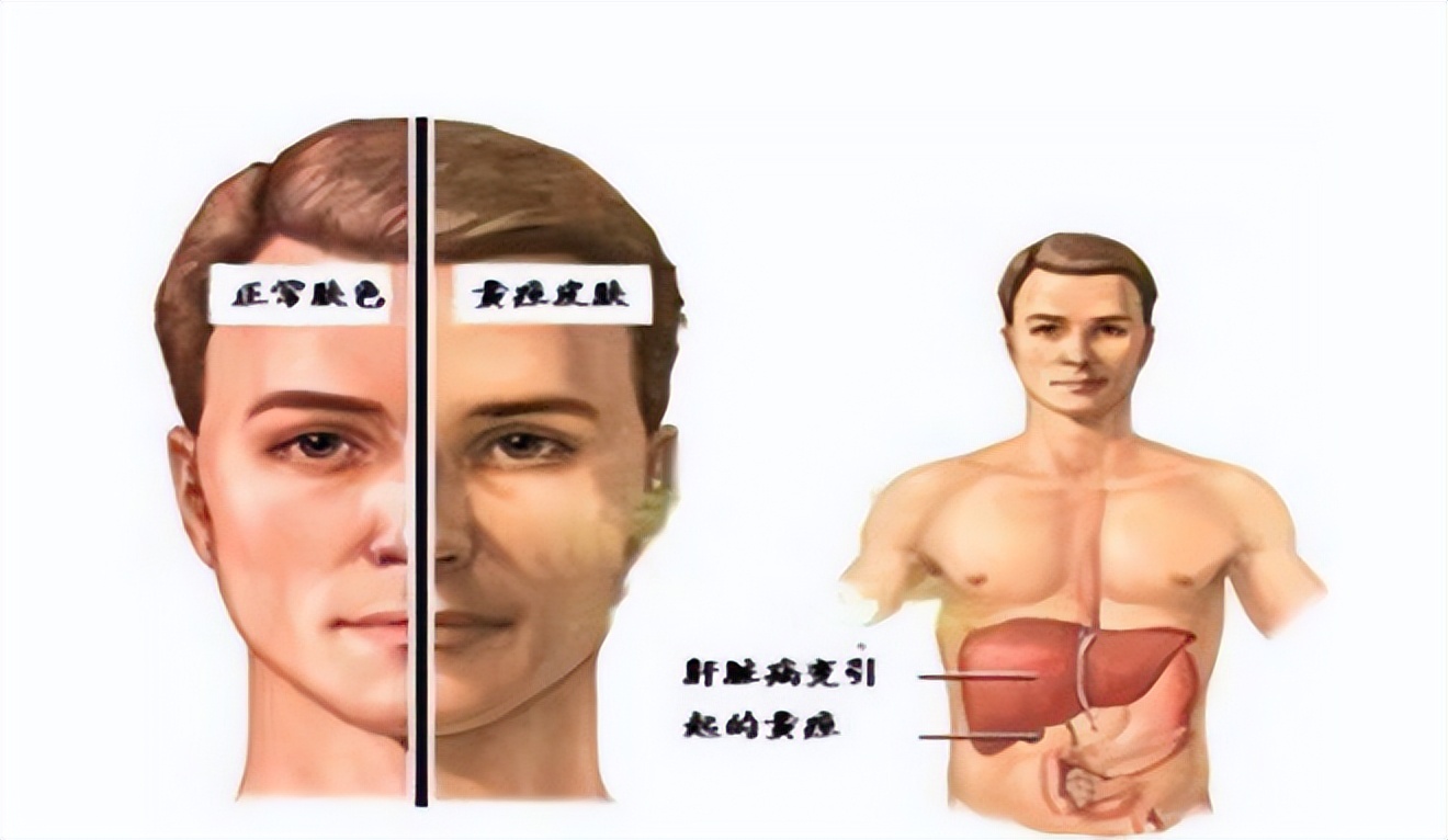 上腹部疼如何区分胃病和胰腺癌,胃痛不一定都是胃病要警惕胰腺癌