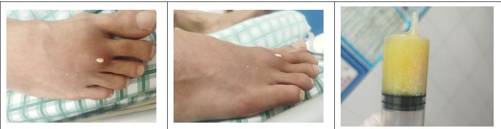 痛风石最简单的解释,世界痛风日是哪一天