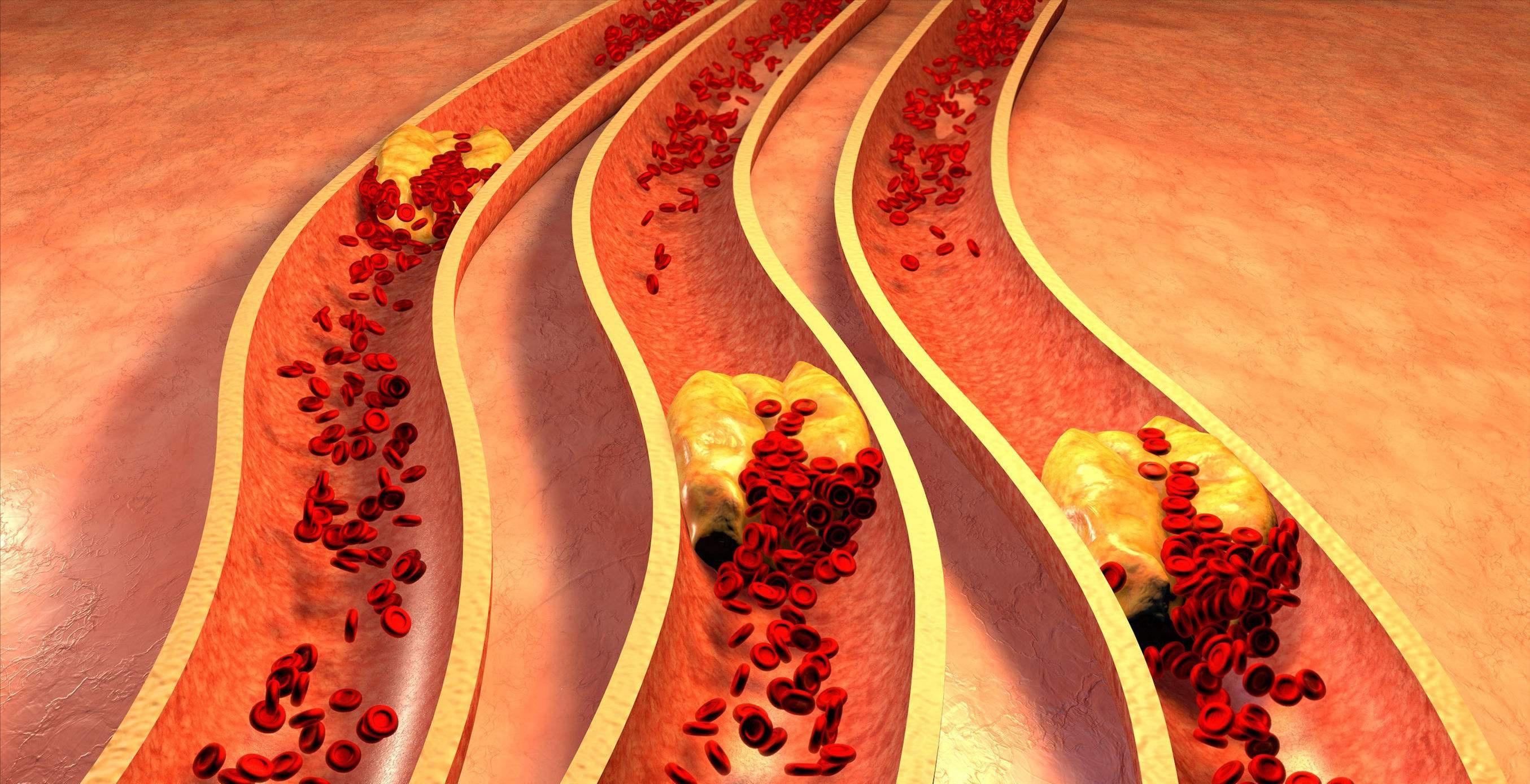 痰瘀阻络型中风偏瘫吃什么中成药,治疗脑卒中的方子