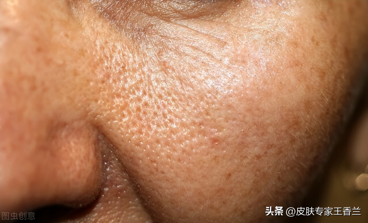皮肤出油毛孔粗大起痘痘怎么回事,多油毛孔粗大皮肤粗糙容易长痘痘