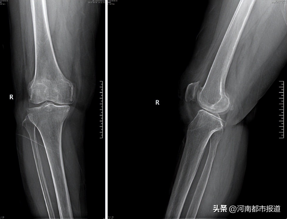 全球首例3d打印距骨表面假体置换,首例医生3d打印距骨表面植入人体