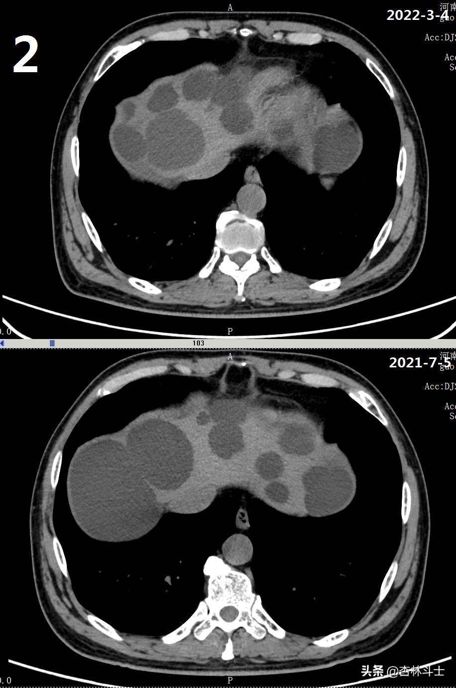 64岁银行职员患肝囊肿，CT引导下细针穿刺抽吸酒精硬化解决大问题