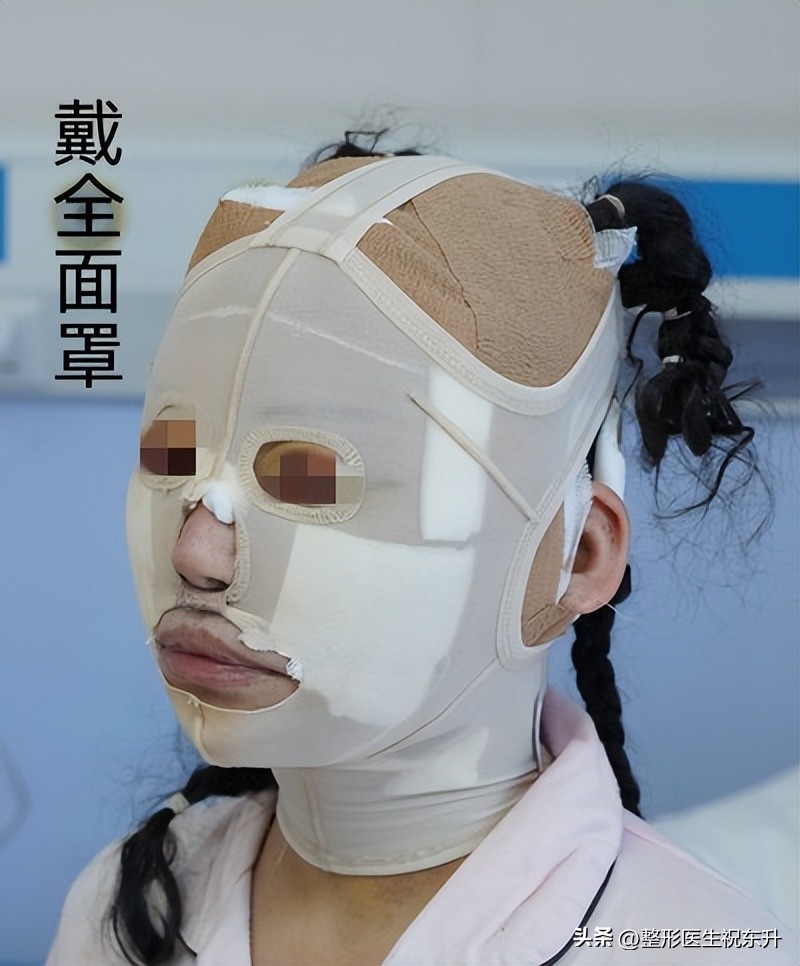 想要做拉皮手术怎么选择医院,面部拉皮手术真实经历