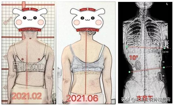 脊柱侧弯成年后会加重吗,成年后才发现脊柱侧弯