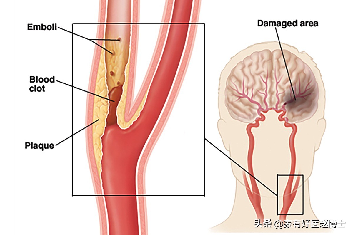 超声颈动脉可以查出什么原因,超声颈动脉斑块的危险评估