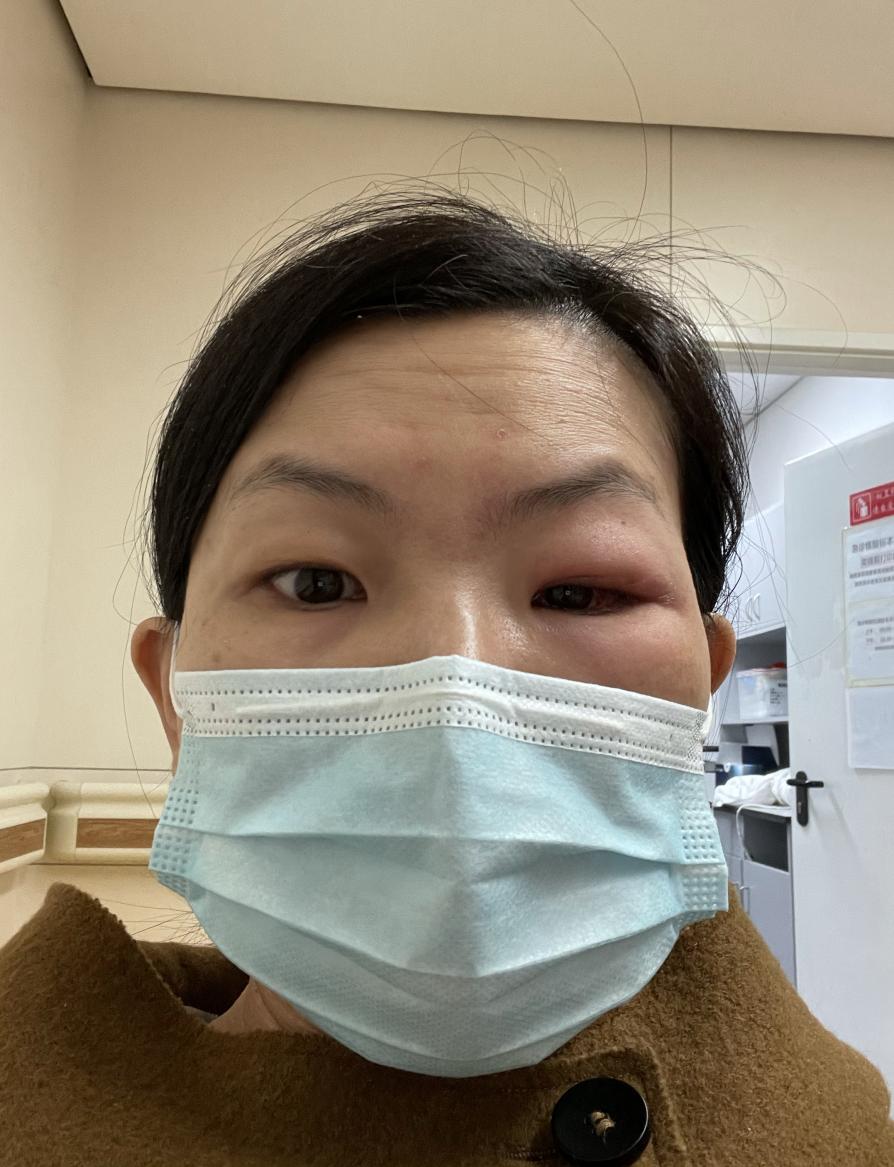 眼眶蜂窝织炎看病经验分享,患了急性眼眶蜂窝织炎如何治疗