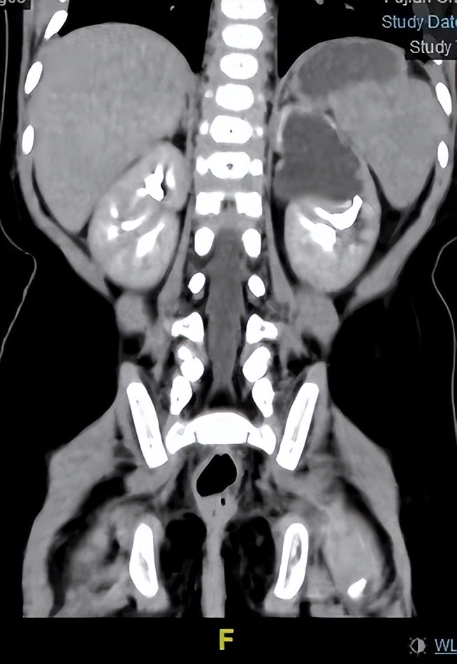 重复肾、重复输尿管是怎么回事？有哪些表现？需要手术吗？